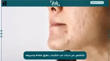 للتخلص من ندبات حب الشباب بطرق فعالة وسريعة